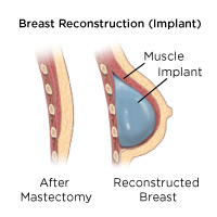 Breast Reconstruction