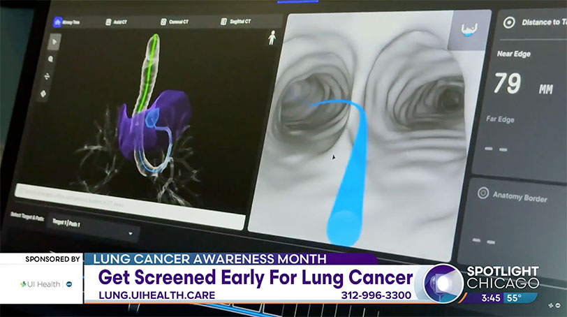 Shifting the Curve to Early Lung Cancer Diagnosis