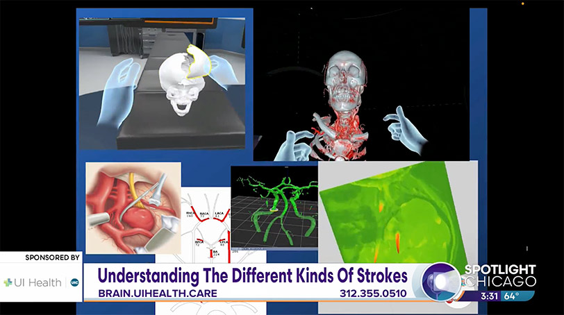 BE FAST: Recognize, Treat, and Prevent a Stroke